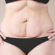 Lipœdème et relâchement abdominal