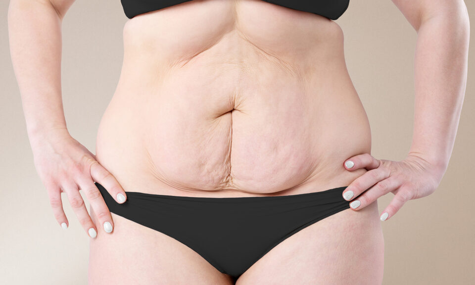 Lipœdème et relâchement abdominal