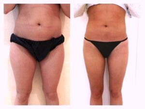 Liposuccion des jambes et abdominoplastie