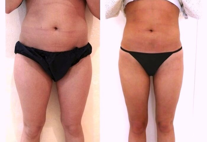 Liposuccion des jambes et abdominoplastie