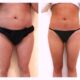 Liposuccion des jambes et abdominoplastie