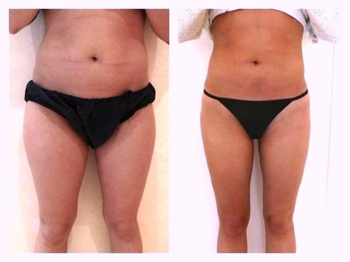 Liposuccion des jambes et abdominoplastie