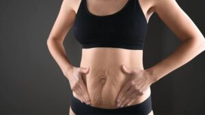 Raffermissement du ventre après liposuccion