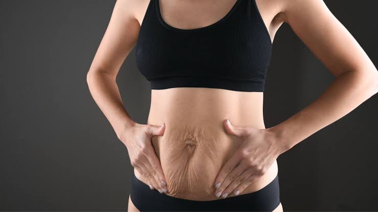 Raffermissement du ventre après liposuccion