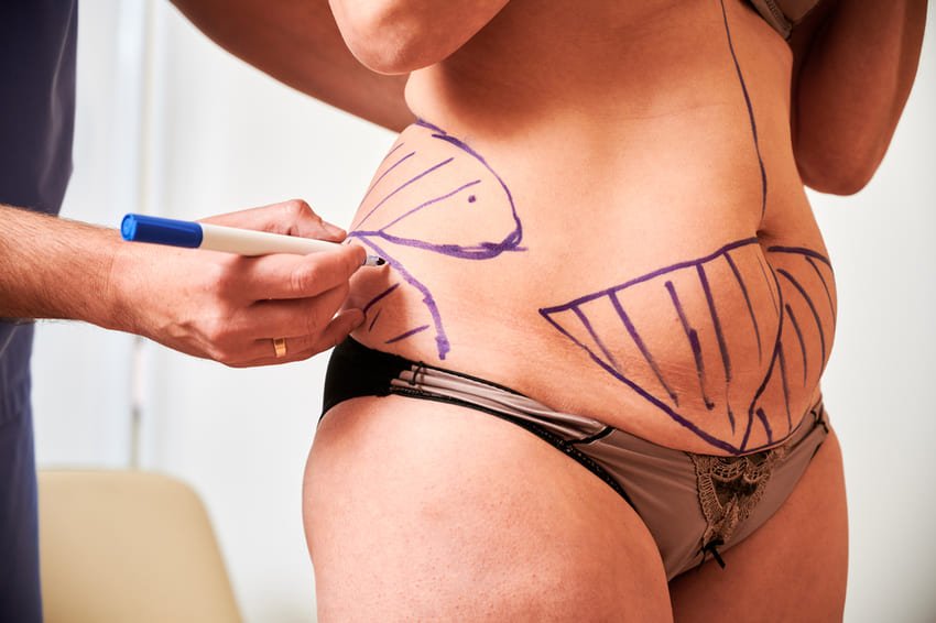 Abdominoplastie 360°