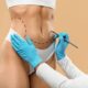 Abdominoplastie assistée par liposuccion VASER