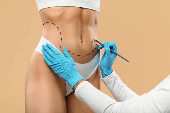 Abdominoplastie assistée par liposuccion VASER
