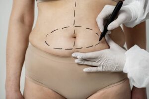 Abdominoplastie avec liposuccion 360°