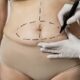 Abdominoplastie avec liposuccion 360°