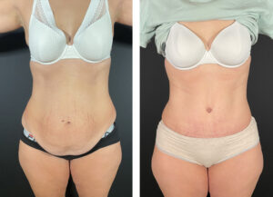 Abdominoplastie avec liposuccion des flancs
