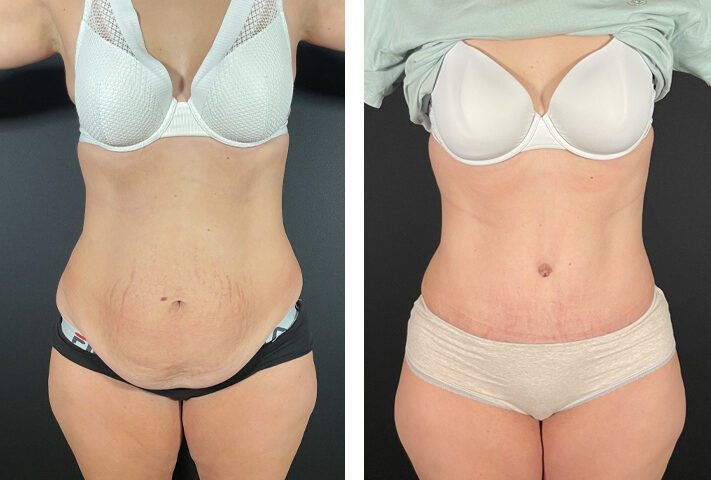 Abdominoplastie avec liposuccion des flancs
