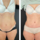 Abdominoplastie avec liposuccion des flancs