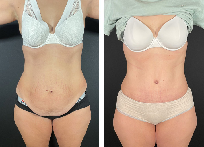 Abdominoplastie avec liposuccion des flancs