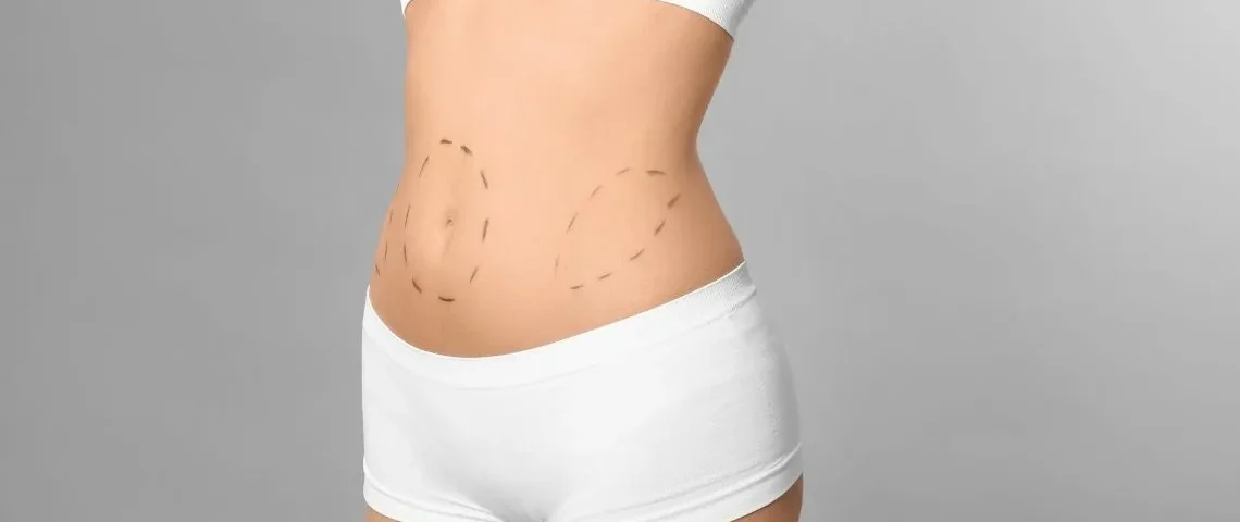 Abdominoplastie avec VASER et BodyTite