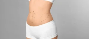 Abdominoplastie avec VASER et BodyTite