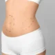 Abdominoplastie avec VASER et BodyTite