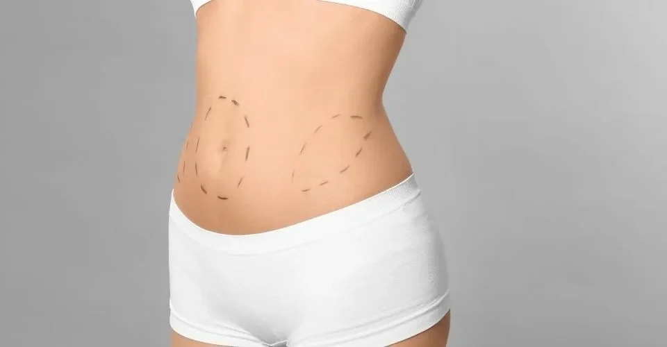 Abdominoplastie avec VASER et BodyTite