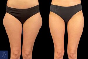Abdominoplastie avec lifting des cuisses