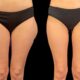 Abdominoplastie avec lifting des cuisses