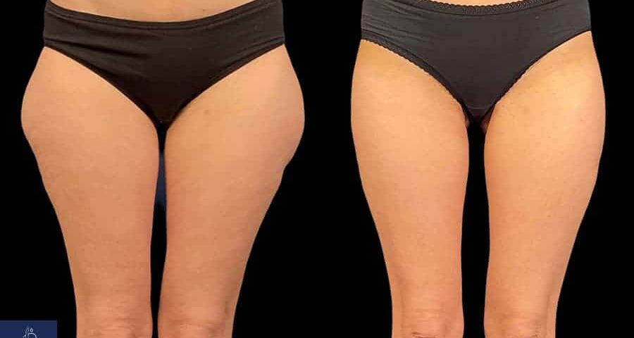 Abdominoplastie avec lifting des cuisses
