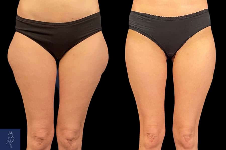 Abdominoplastie avec lifting des cuisses