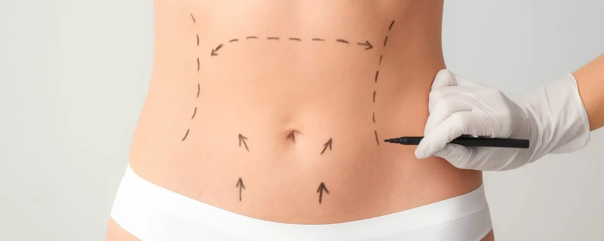 Abdominoplastie haute tension supérieure