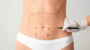 Abdominoplastie haute tension supérieure