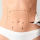 Abdominoplastie haute tension supérieure
