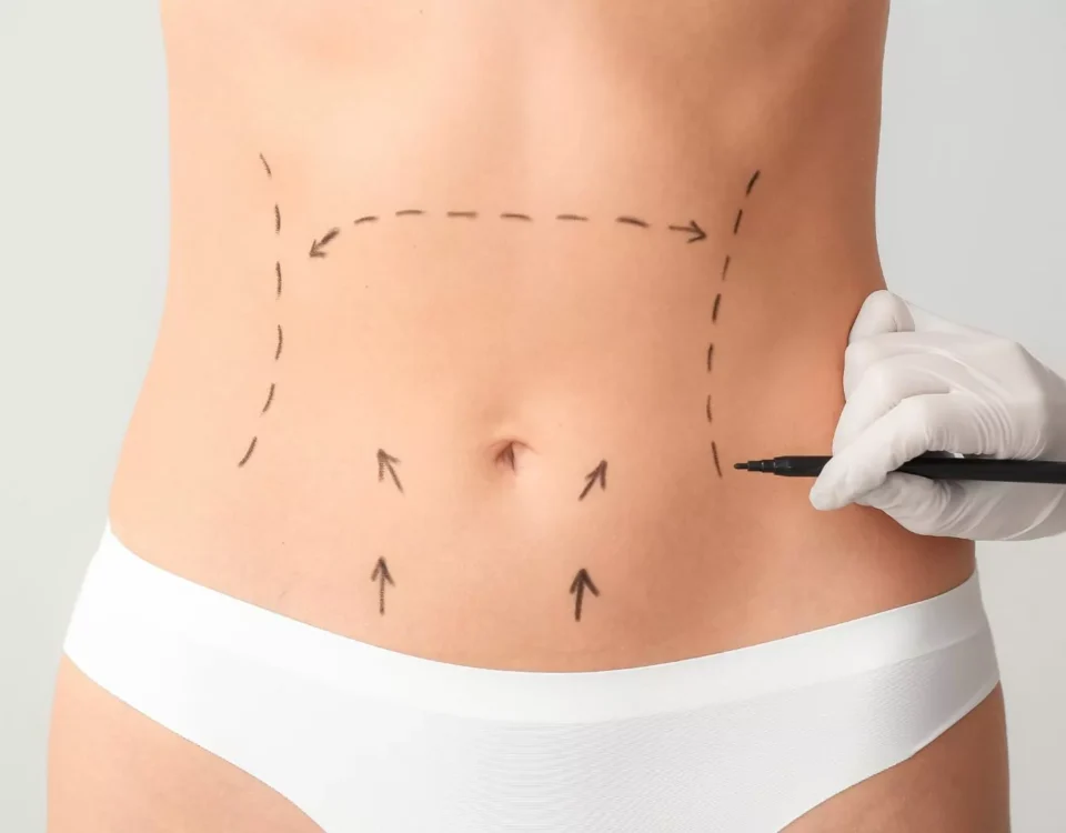 Abdominoplastie haute tension supérieure