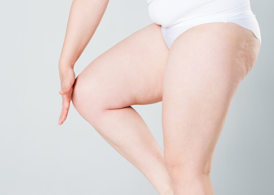 Lipœdème et excès cutané abdominal