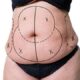 Abdominoplastie Fleur de Lys Tunisie