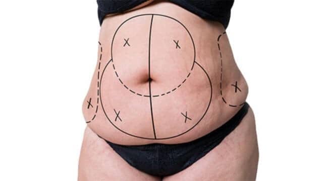 Abdominoplastie Fleur de Lys Tunisie