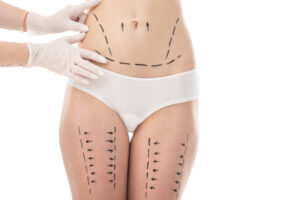 Abdominoplastie ou BodyTite