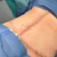 Lipœdème et abdominoplastie