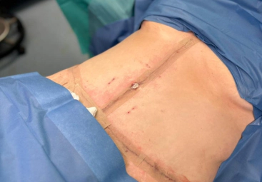 Lipœdème et abdominoplastie