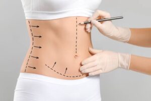 Liposuccion du lipœdème puis abdominoplastie