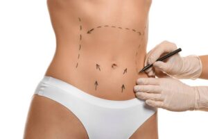 Liposuccion haute définition du ventre