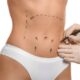 Liposuccion haute définition du ventre