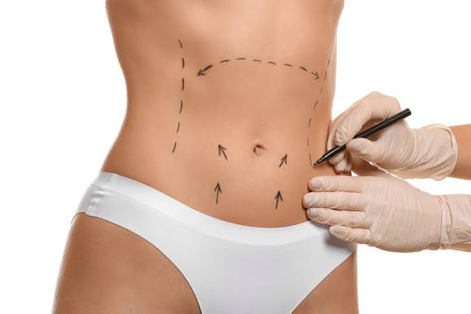 Liposuccion haute définition du ventre