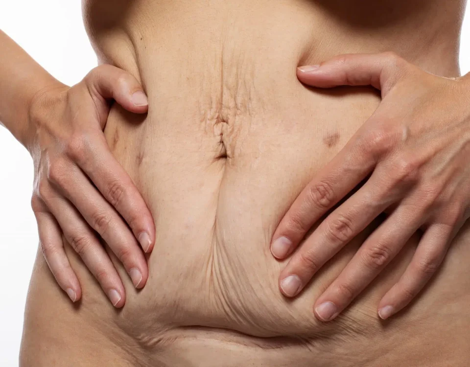 Peau abdominale fripée après une grossesse